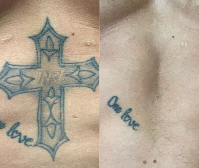 Tatoveringsfjernelse — kors på mave, før og efter