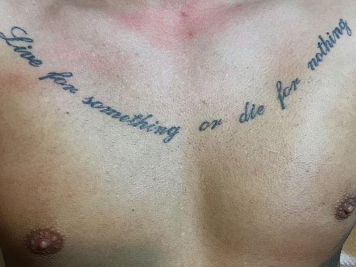 Før behandling — brystkasse