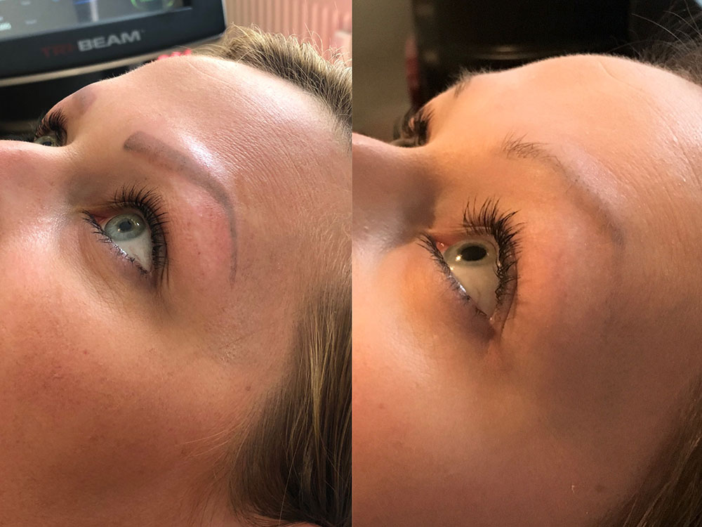Fjernelse af permanent makeup
