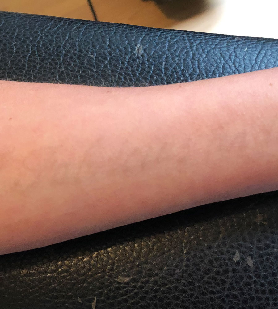 Efter behandling — profil